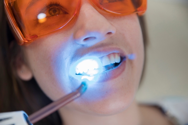 5 preguntas comunes sobre el blanqueamiento dental