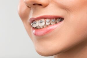 ¿Qué tratamiento de ortodoncia me conviene más?