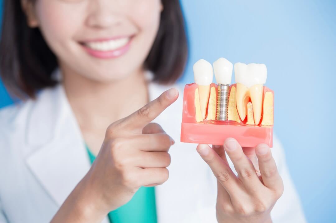 ventajas-implantolgia-dental